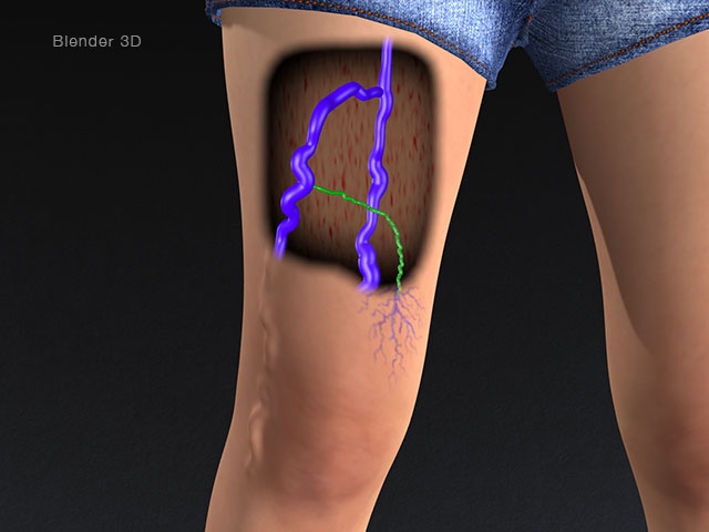 Varicose Veins with Blender - Wendy Dunham